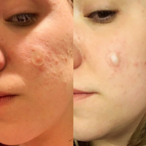 Hidrokolloid Bant Roll