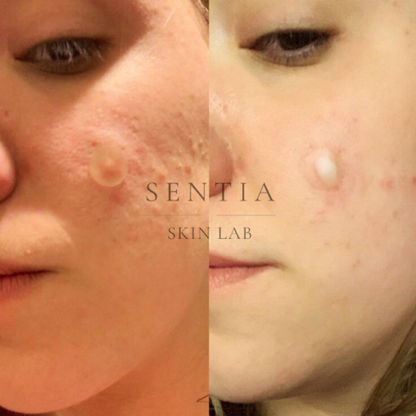 Sentia Yıldız Sivilce Bandı (40lı paket)