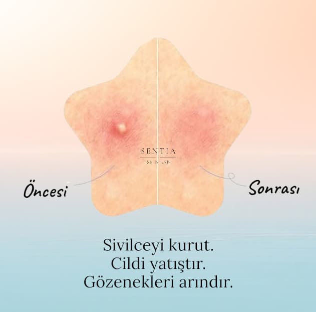 Sentia Yıldız Sivilce Bandı (40lı paket)